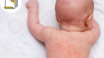 Thumbnail of Eczema