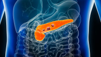 Thumbnail of Precision Radiotherapy for Pancreatic Cancer: MR-guided, Stereotactic Body Radiotherapy (SBRT), and Real-Time Tracking  (Chinese Only)