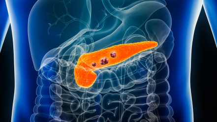 Thumbnail of Precision Radiotherapy for Pancreatic Cancer: MR-guided, Stereotactic Body Radiotherapy (SBRT), and Real-Time Tracking (Chinese Only)