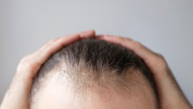 Thumbnail of Hair Loss Treatment: Half of Men, One-Third of Women Over 50 Face Hair Loss — Hair Growth Lotion Is First-Line