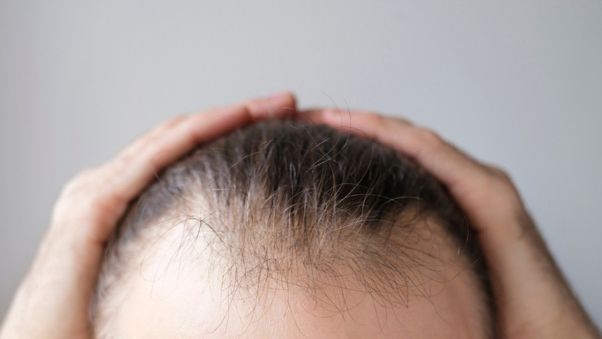 Hair Loss Treatment: Half of Men, One-Third of Women Over 50 Face Hair Loss — Hair Growth Lotion Is First-Line
