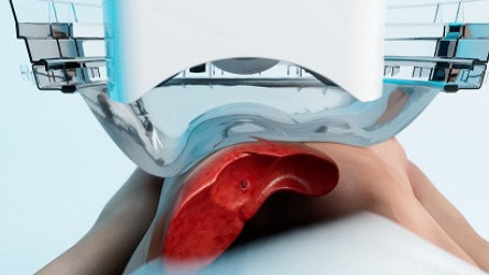 Thumbnail of Revolutionary Non-Invasive Histotripsy Treatment for Liver Cancer to Launch in May