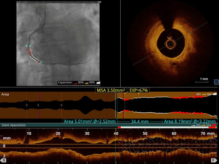 Optical Coherence Tomography: Co-registration Photo with 3D Stent Rendering & 3D Visual Angioscopy
