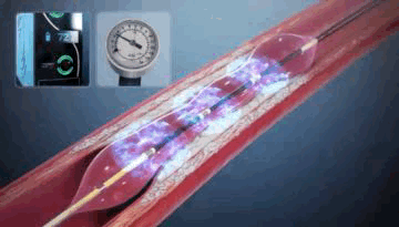 Shockwave Intravascular Lithotripsy (IVL)