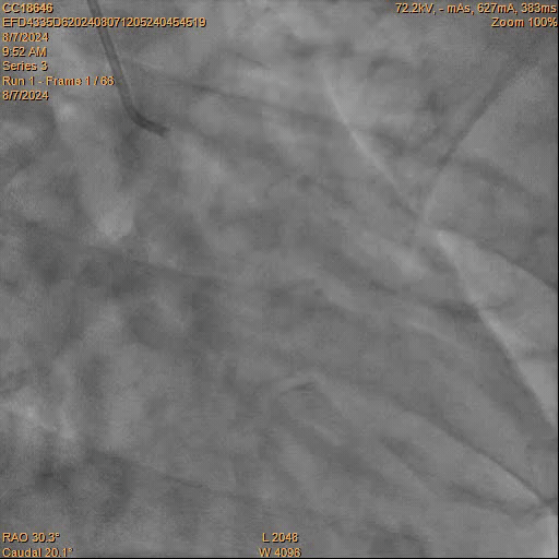 Coronary Angiogram before Stenting