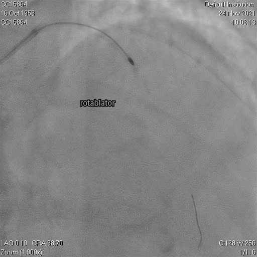 Rotational Atherectomy