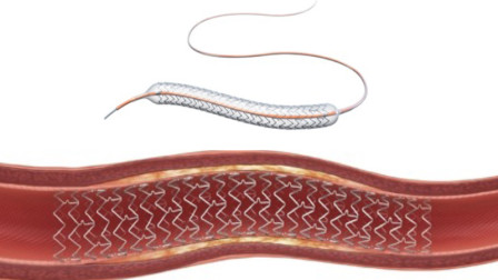 Coronary Stent