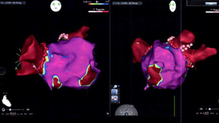 3D Mapping in Electrophysiological Study 