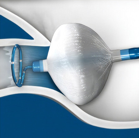 Cryoablation