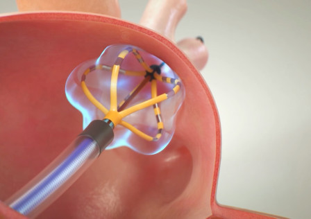 Pulsed Field Ablation