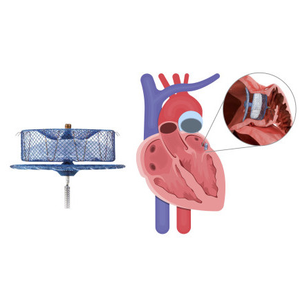 Thumbnail of Transcatheter Implantation of Left Atrial Appendage Occluder (LAAO)