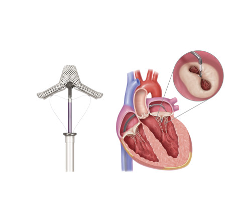 Thumbnail of Transcatheter Mitral/Tricuspid Valve Repair Intervention with Transcatheter Edge-to-edge Repair (TEER) Device