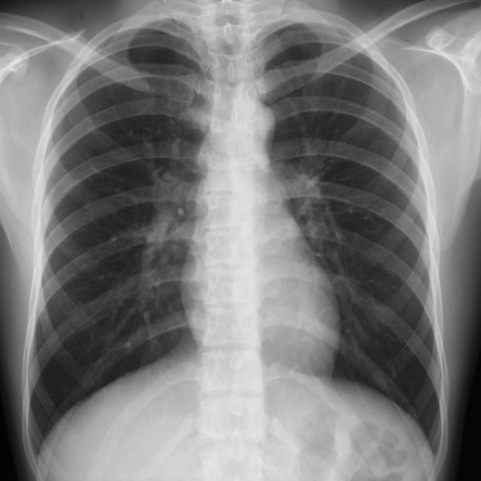 Thumbnail of Are X-rays Safe?
