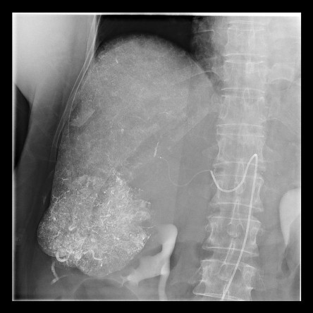 Thumbnail of Vascular Interventional Radiology