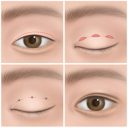 Thumbnail of Minimal Incision Method