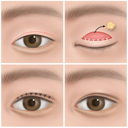 Thumbnail of Open Incision Method