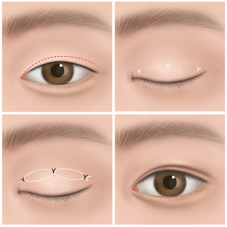 Thumbnail of Suturing (Non-Incision Method)