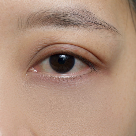 縮圖 - 眼瞼外開法