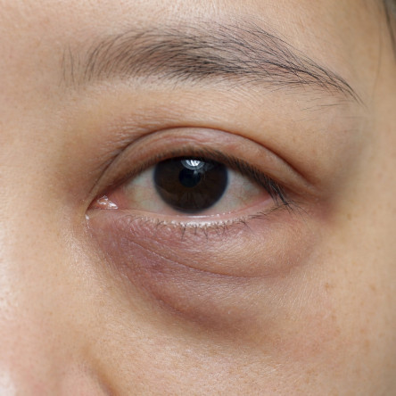 縮圖 - 眼內結膜切除術
