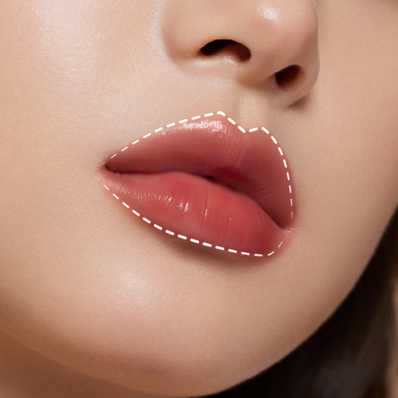 Thumbnail of Hyaluronic Acid Injection