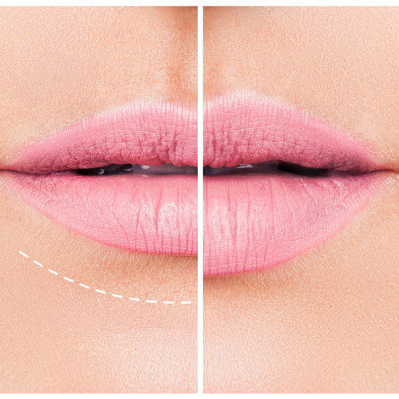 Thumbnail of Lip Reduction Surgery