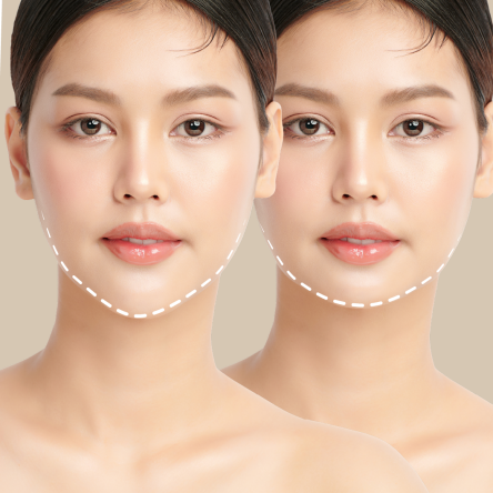 Thumbnail of Chin Augmentation with Implant