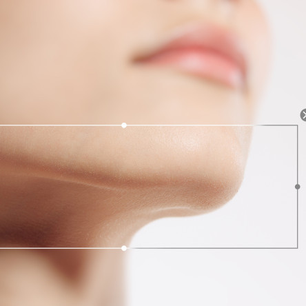 Thumbnail of Chin Reduction Surgery