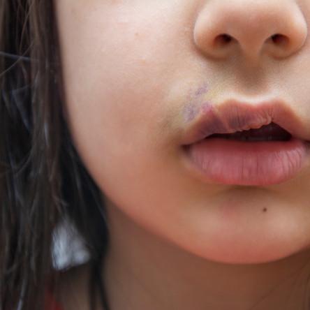 Thumbnail of Surgeries For Post-cleft Deformities Of The Lip & Nose