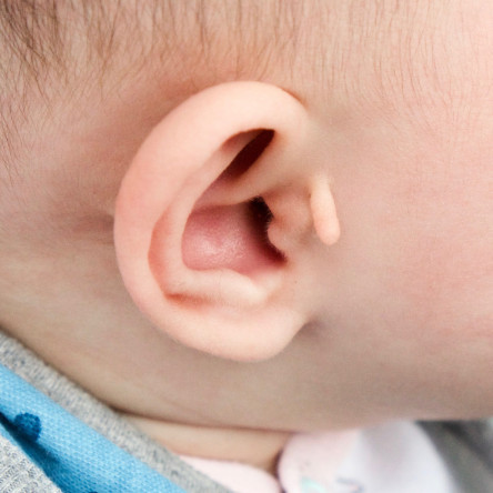 Thumbnail of Accessory Auricles