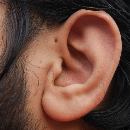 Thumbnail of Preauricular Sinuses