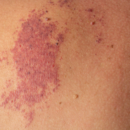 Thumbnail of Haemangiomas