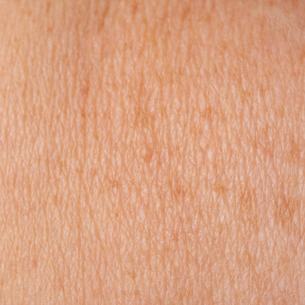 Thumbnail of Congenital Skin Tumour