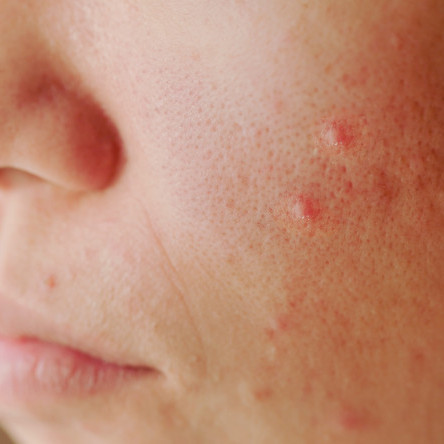 Thumbnail of Depressed Scar