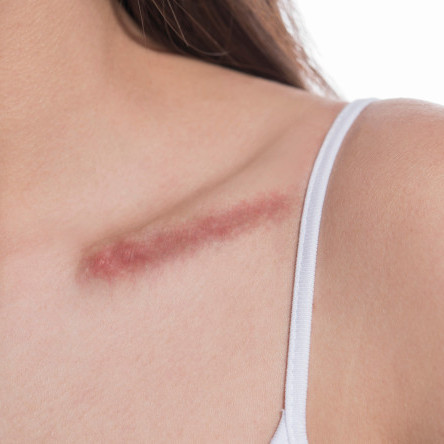 Thumbnail of Hypertrophic Scar