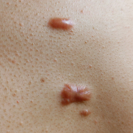 Thumbnail of Keloid Scar