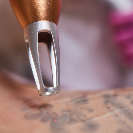 Thumbnail of Pigmented Skin Lesions