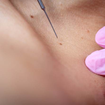 Thumbnail of Vascular Lesions Removal
