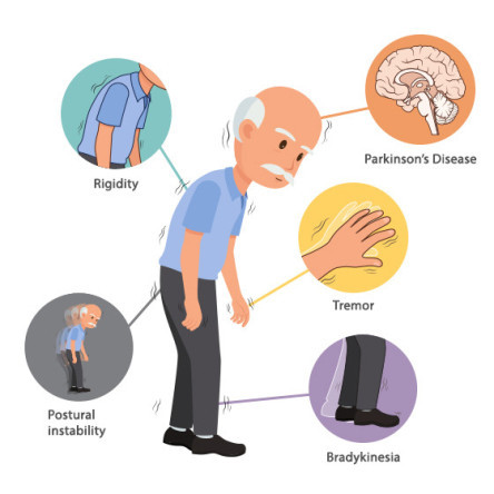 Thumbnail of What&nbsp;is Parkinson’s&nbsp;Disease?
