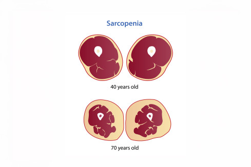 Thumbnail of Do I have sarcopenia?