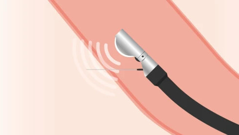Thumbnail of Endoscopic Ultrasound (EUS)