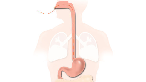 Thumbnail of High Resolution Oesophageal Impedance Manometry (HRIM)