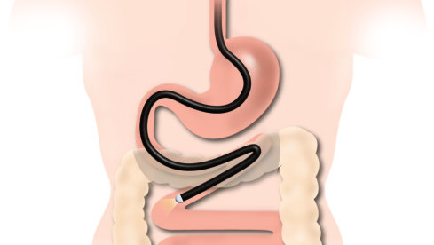 Thumbnail of Enteroscopy
