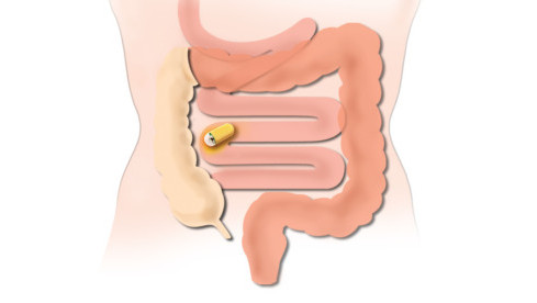 Thumbnail of Capsule Endoscopy