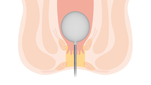 Thumbnail of Anorectal Manometry