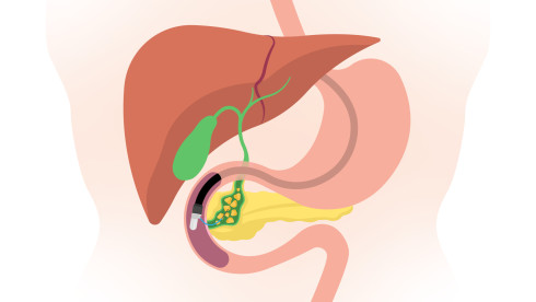 Thumbnail of Endoscopic Retrograde Cholangiopancreatography (ERCP)