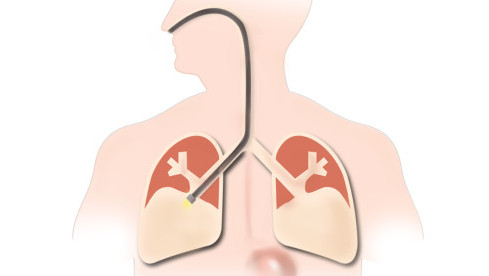 Thumbnail of Bronchoscopy