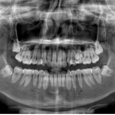 Thumbnail of Extraction of Erupted or Impacted Wisdom Teeth&nbsp;