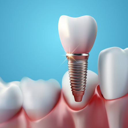 Thumbnail of Implant Dentistry