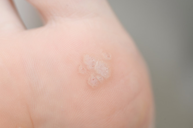 Thumbnail of Warts/Verrucae of the Feet