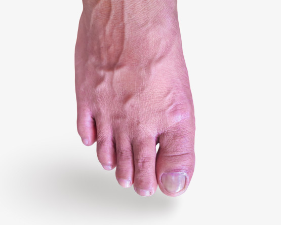 Thumbnail of Peripheral Vascular Disease